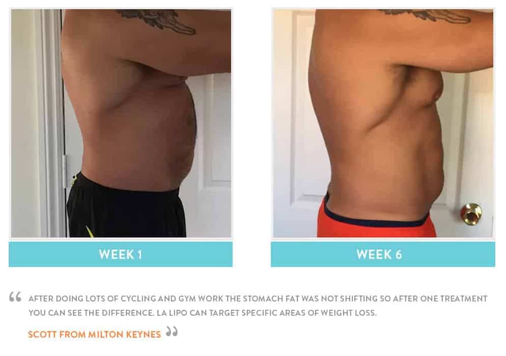 Before & After Stomach Fat Greater London (Merton)