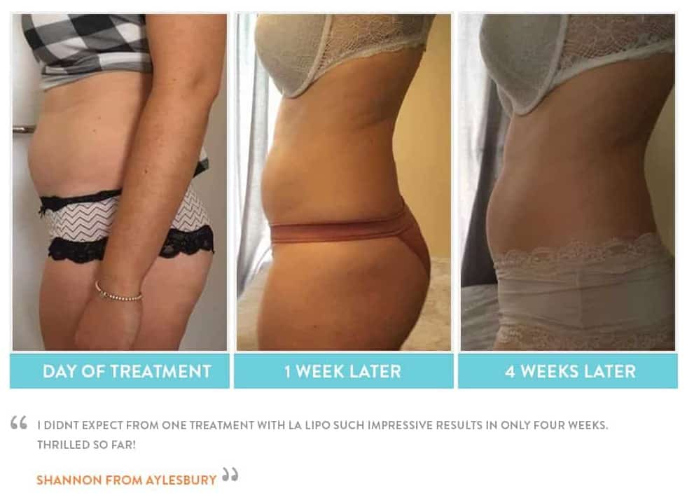 before, Cryolipolysis Greater London (Merton)