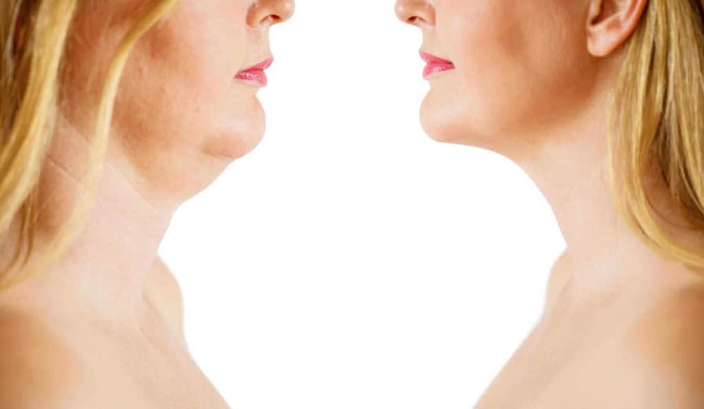 Double Chin treatment Greater London (Merton) before and after results