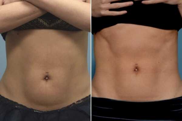 body sculpting FAQs Greater London (Merton)