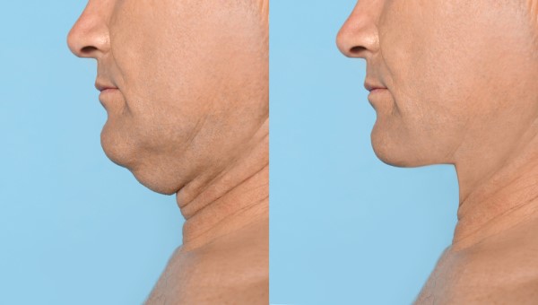 Which Non-Surgical Treatments Work Best for Jowls and Loose Skin Greater London (Merton)?
