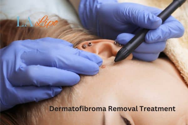 Dermatofibroma Removal Treatment Greater London (Merton)