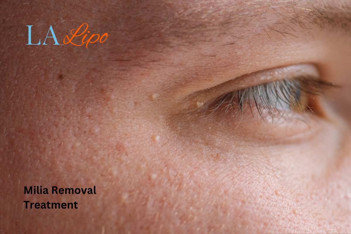 Cryopen Milia Removal: Is It the Easiest and Safest Option Greater London (Merton)?
