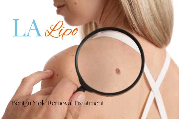 Why getting moles removed Greater London (Merton) can boost your confidence!