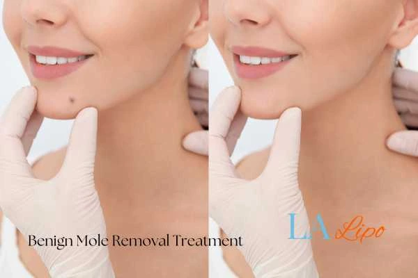 woman's before and after mole removal Greater London (Merton) results
