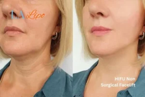 hi-fu for wrinkles Greater London (Merton) before and after results