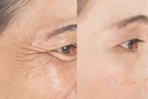 Before and after results of woman - HI-fu wrinkles reduction treatment Greater London (Merton)