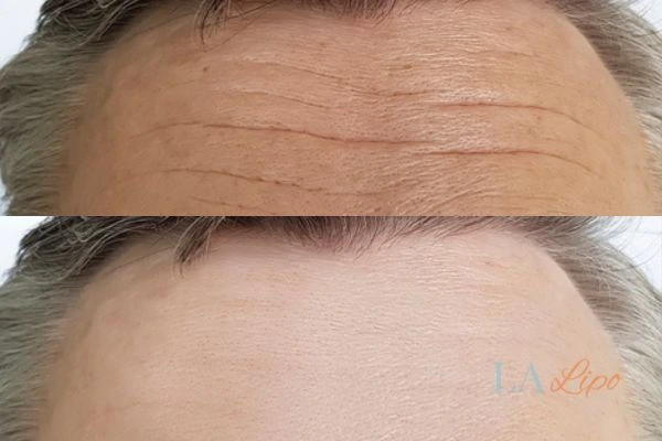 results of HIFU Greater London (Merton) on mans forehead to help reduce lines and wrinkles