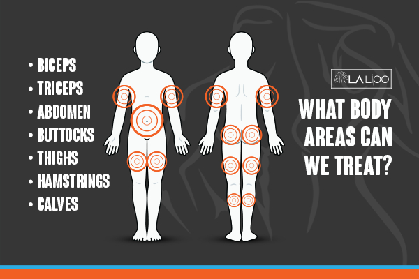 Graphic to show areas you can have LA-EMS Body Sculpting Greater London (Merton) treatment.