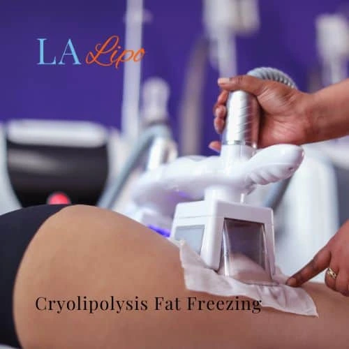 fat freezing - Cryolipolysis Greater London (Merton)