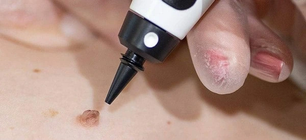 skin tag removal using cryopen Greater London (Merton)