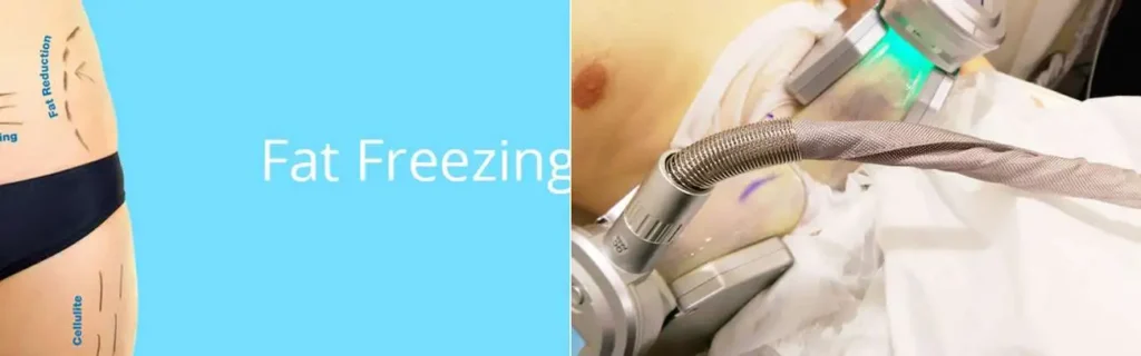 multi areas of a persons body having coolsculpting Greater London (Merton) treatment