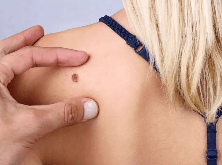 woman having mole removal Greater London (Merton) consultation before treatment.