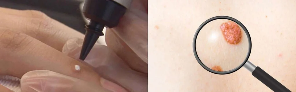 Person getting moles removed with cryopen Greater London (Merton)