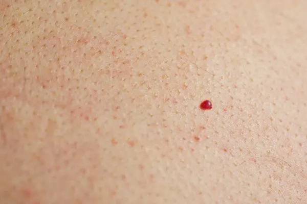 close up of a cherry angioma Greater London (Merton)