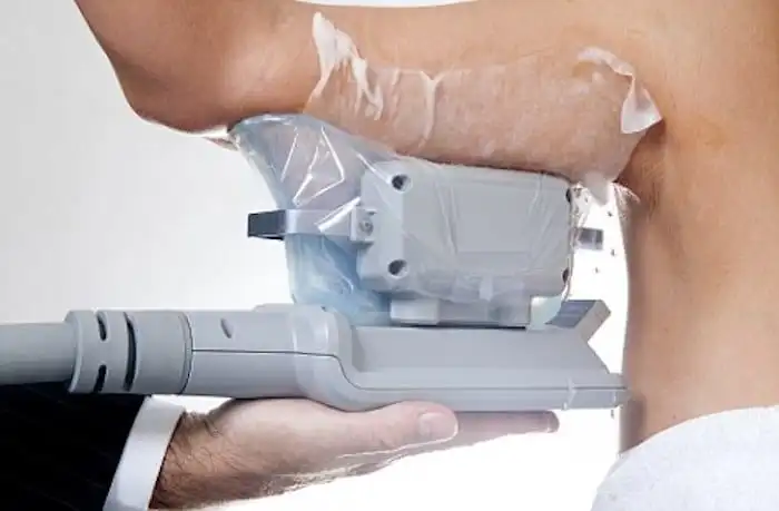 Picture of fat freezing Greater London (Merton) on the upper arms.
