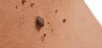 image of a skin tag Greater London (Merton)
