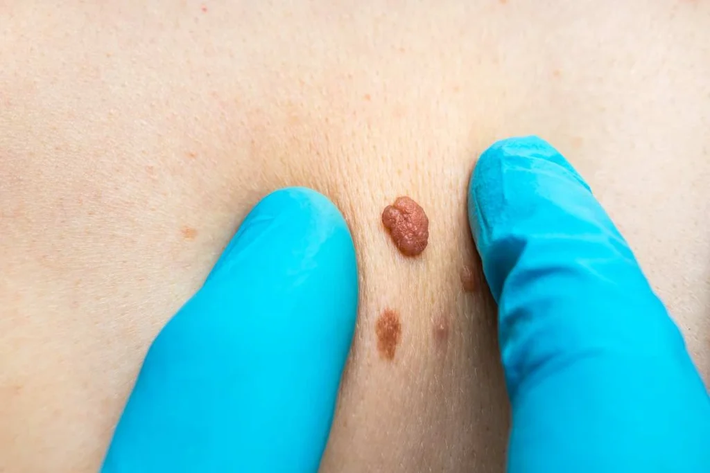 Consultant examining a skin tag Greater London (Merton)
