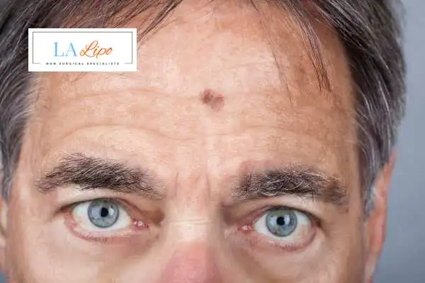 Solar Lentigo Removal Greater London (Merton) image of man with mark on his forehead