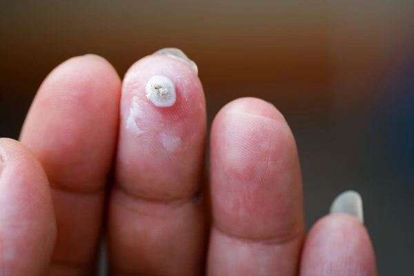 wart on person finger - cryotherapy to treat from LA LIPO Greater London (Merton)
