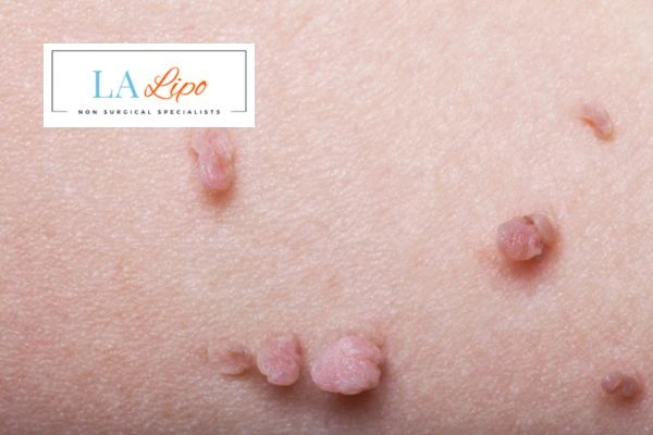 Does cryopen skin tag removal Greater London (Merton) hurt? Find out now call our team today!