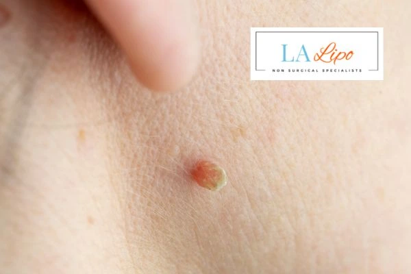 Book skin tag removal Greater London (Merton) today speak to our team now!