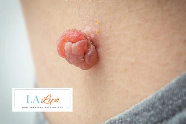 Interested in skin tag removal Greater London (Merton)? Concerned about the pain? Find out more today!