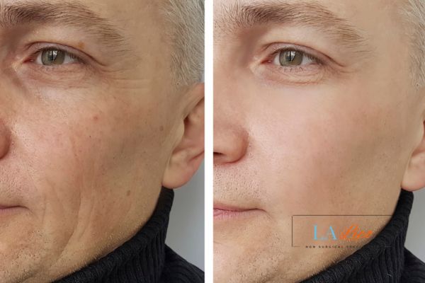 See the amazing results of Morpheus8 Treatment Greater London (Merton)!