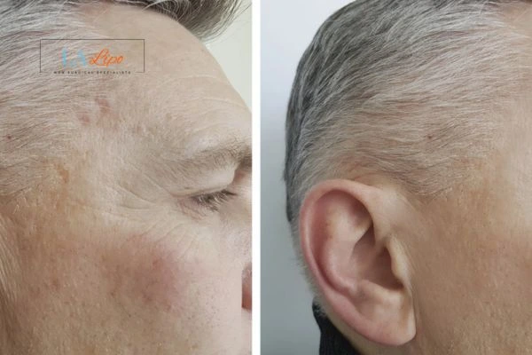 Mens Before & After Morpheus 8 Results Greater London (Merton)