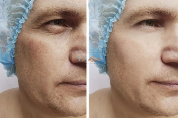 Before and after Morpheus 8 Results Greater London (Merton)