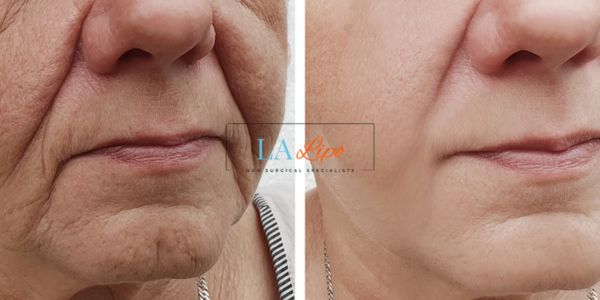 Older lady deeper wrinkle reduction - LA LIPO Morpheus 8 Results Greater London (Merton)