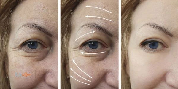 Amazing eye lift Morpheus 8 results Greater London (Merton)