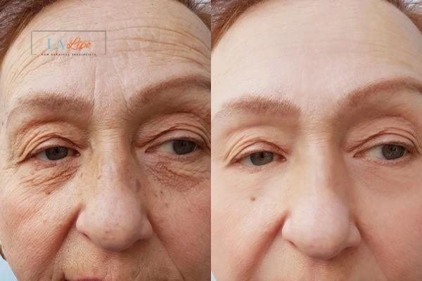The powerful benefits of Morpheus8 Treatment Greater London (Merton) - Call Our team today!