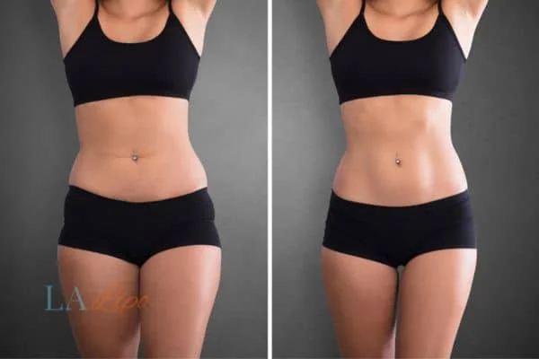 before and after results of non-surgical treatment to help a woman's body image and mental health Greater London (Merton)
