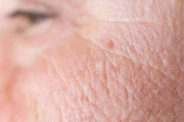 close up picture of a woman's face showing an age spot Greater London (Merton)