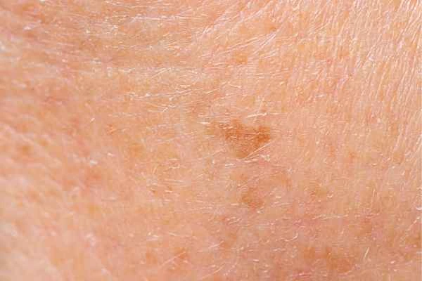 close up picture of age spots Greater London (Merton)