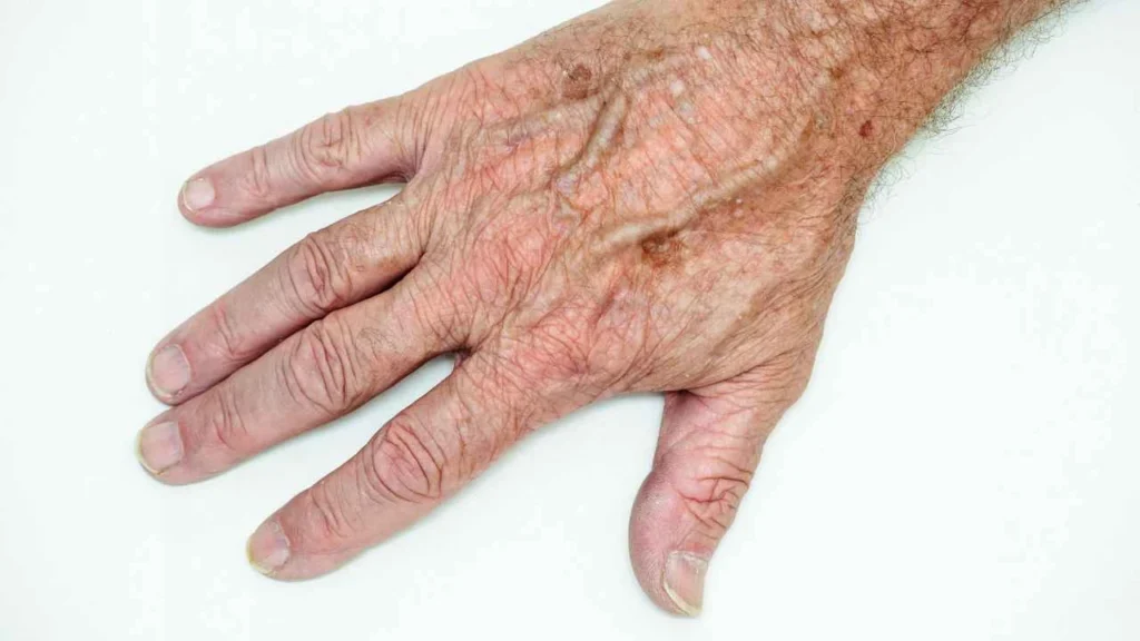 Male hand showing age spot Greater London (Merton)