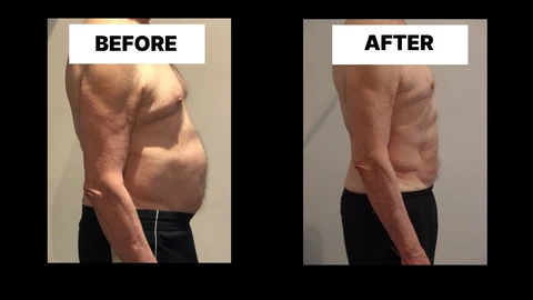 What Symptoms Can Diastasis Recti Cause in Men? Weak Core, Back Pain and Poor Posture Greater London (Merton)